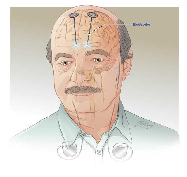 Parkinson hastalarına uygulanan beyin pillerinin ömrü 3-5 yıl olurken bu süre distoniye sahip hastalarda daha kısa.