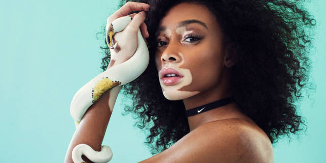 Vitiligo rahatsızlığına rağmen modellik kariyerini aktif olarak sürdüren Winnie Harlow, beden olumlama hareketinin en ünlü temsilcilerinden.